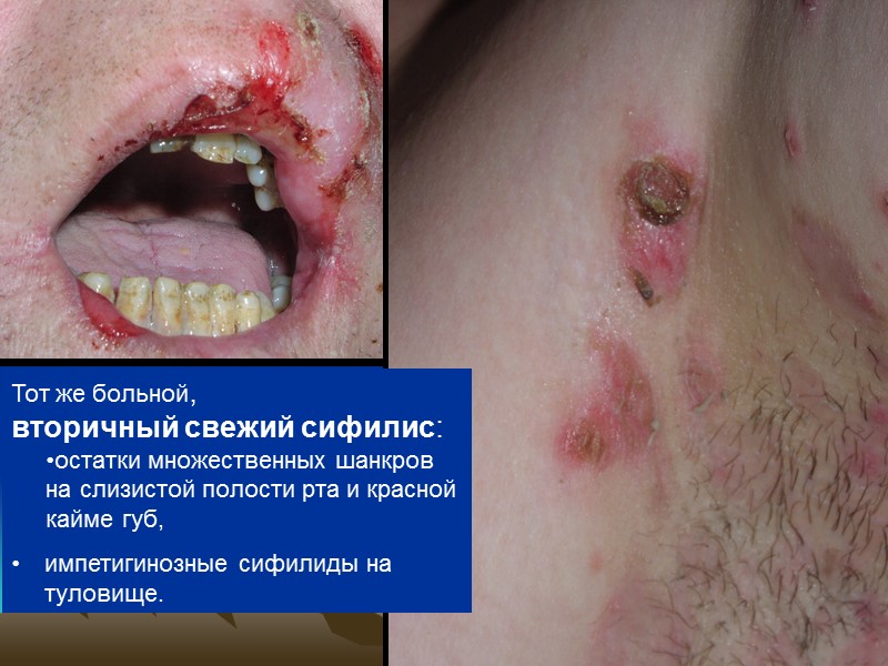 Тот же больной,  вторичный свежий сифилис:  остатки множественных шанкров  на слизистой